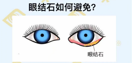 眼結石如何避免