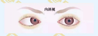 什么是調(diào)節(jié)性內(nèi)斜視？