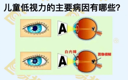 兒童低視力主要病因有哪些?