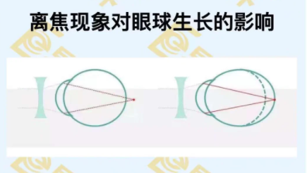 視網(wǎng)膜離焦對眼軸的影響