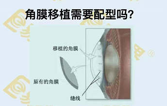 角膜移植需要配型嗎？